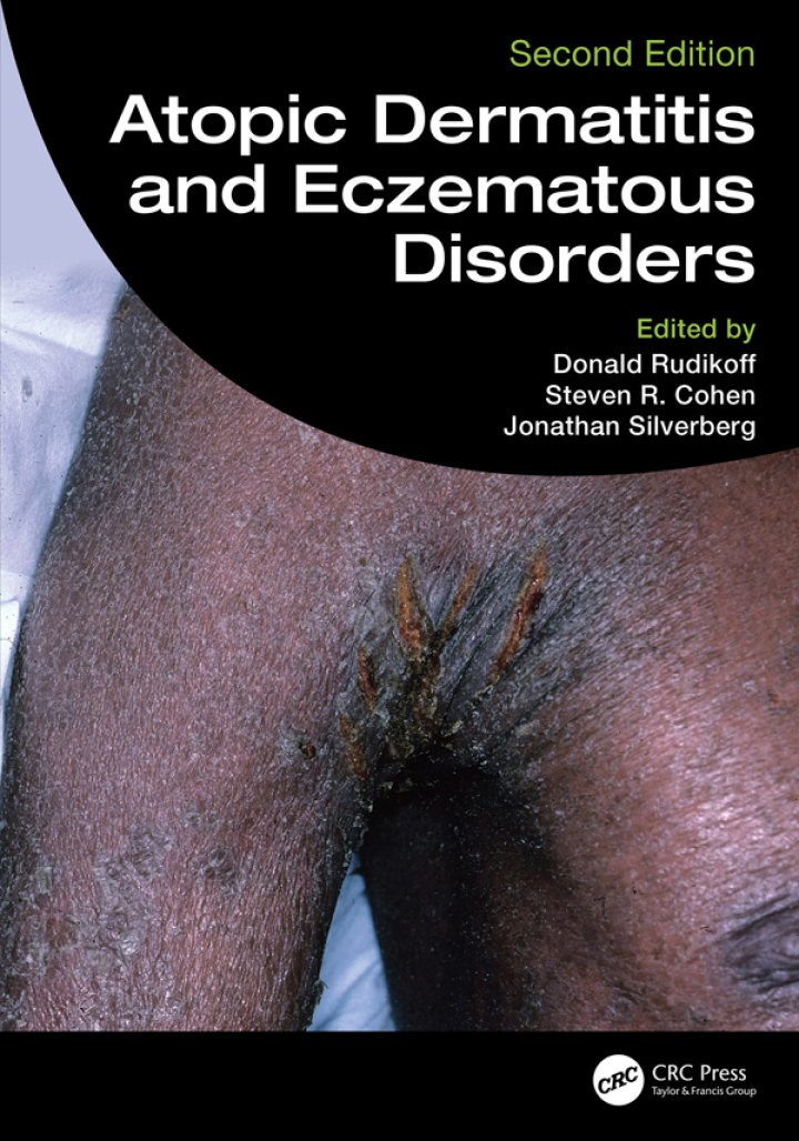 Atopic Dermatitis and Eczematous Disorders 2nd Edition